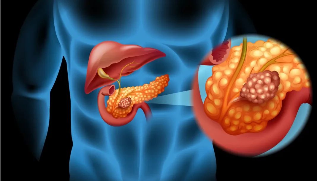 Sinais secretos sob as costelas: cuidado, pode ser câncer de pâncreas!